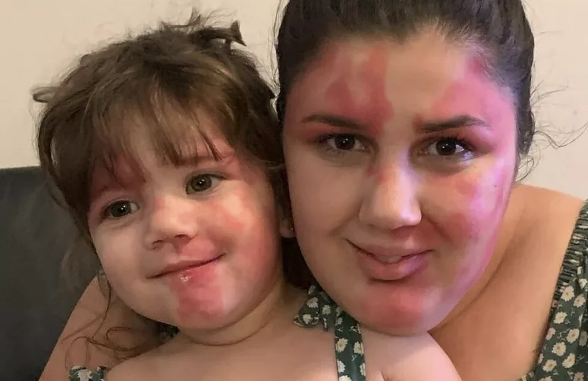 Mom paints face to look like daughter’s heart-shaped port wine birthmark